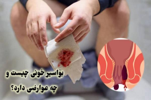 درمان بواسیر خونی چیست؛ علائم + علت و عوارض